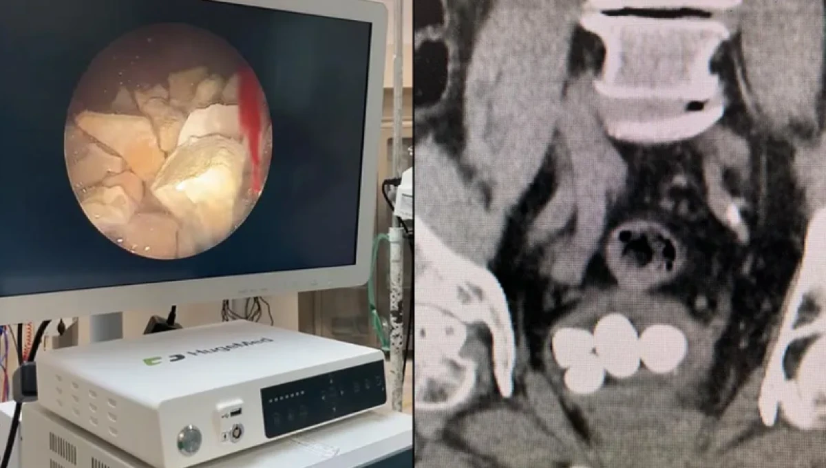 84 yaşındaki hastanın mesanesinden bakın ne çıktı