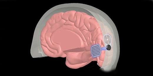 Beyin İmplantları Bakteri Yetiştiriyor! Herkes Tehlikede!