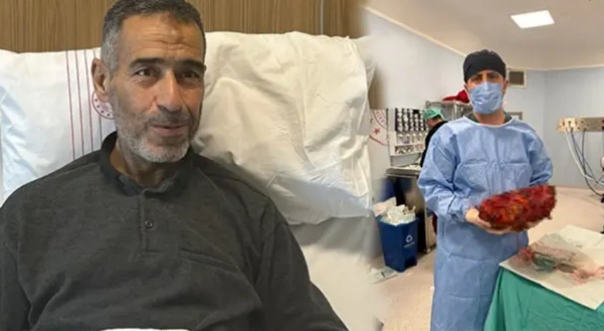 Gaziantep'te 61 yaşındaki adamın 8 kilogramlık b&ouml;breği alındı