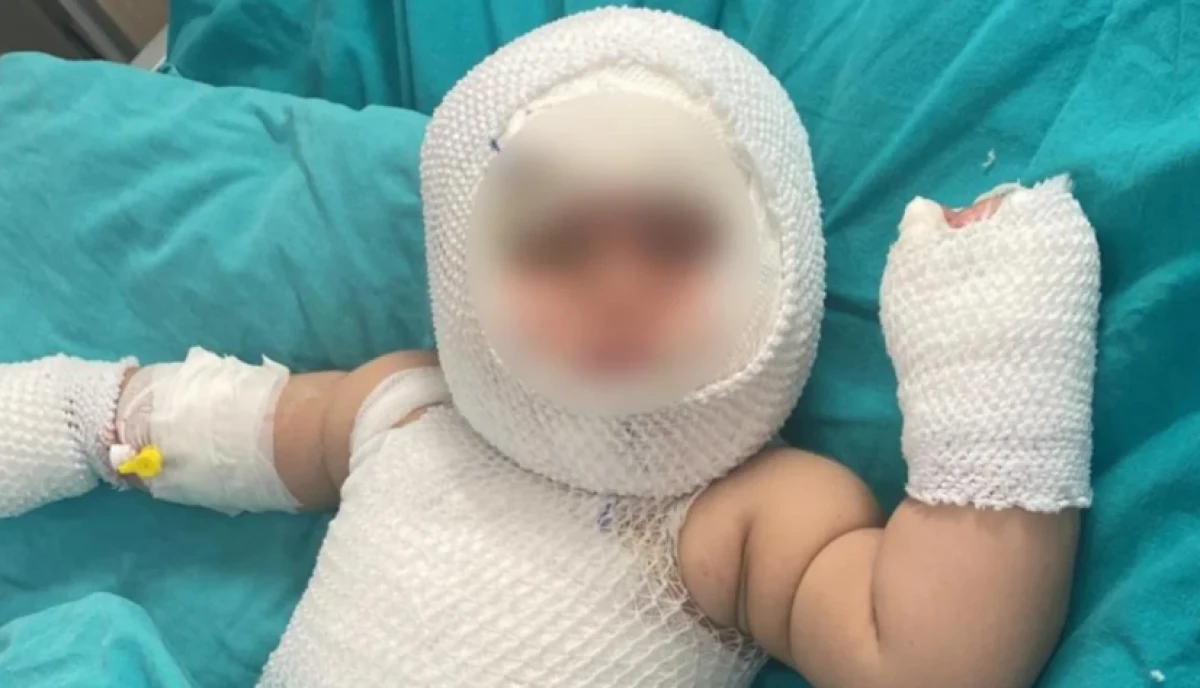 Mersin&rsquo;de Patlayan Domates Konservesi 9 Aylık Eliz Bebeği Yaktı: Aylarca S&uuml;ren Tedavinin Ardından Sağlığına Kavuştu