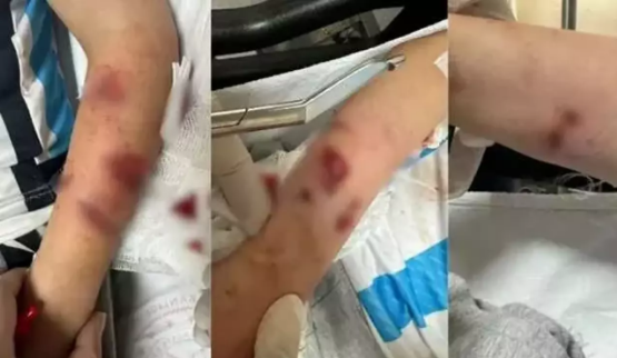 Rize'de sokak köpeklerinin saldırısına uğrayan çocuk yaralandı 