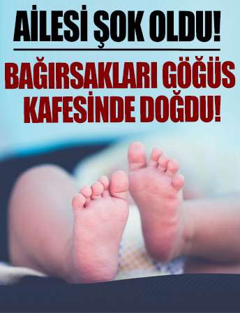 Uşak'taki İlayda bebek, bağırsakları göğüs kafesinde doğdu